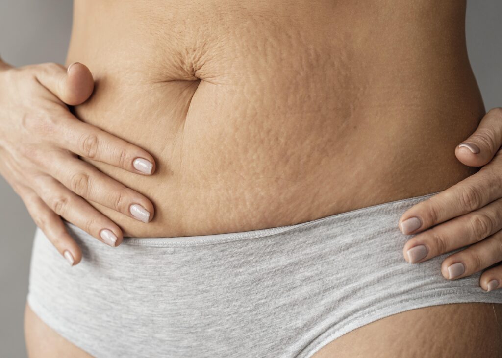 How does collagen help with stretch marks
