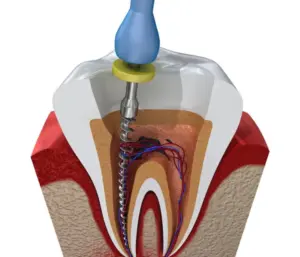 Root canal therapy 