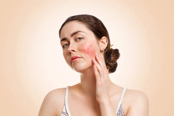 7 Tips For Rosacea Treatment: